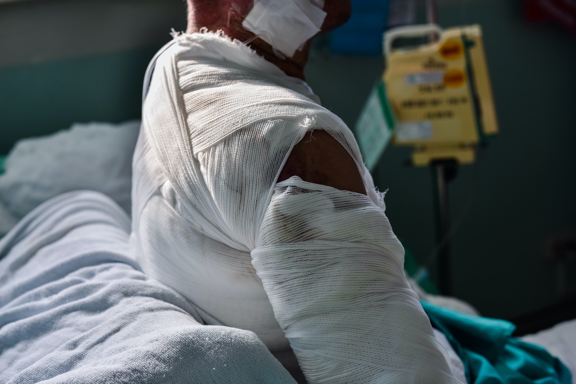 cleveland burn injury lawyer