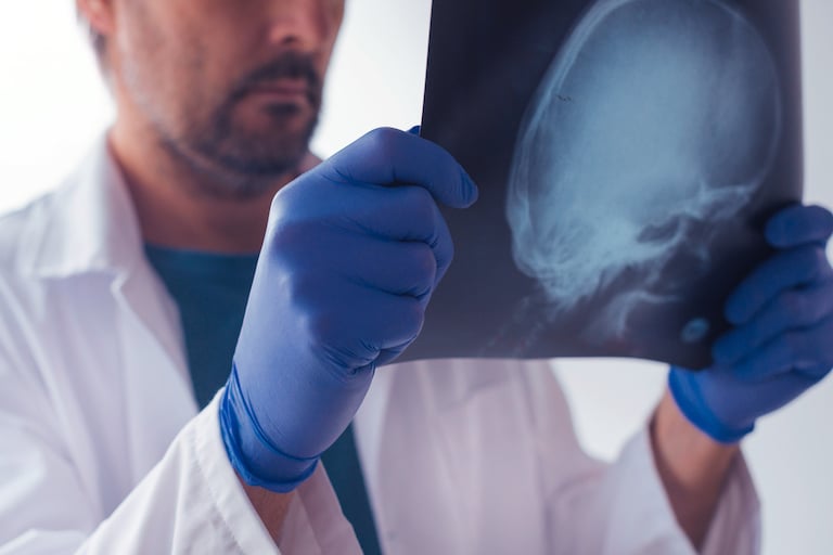 Skull Fracture Injuries