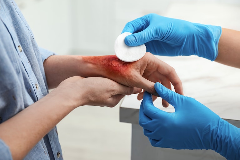 Surprising Sources of Burn Injuries