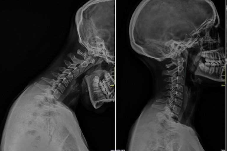 Injuries After an Accident