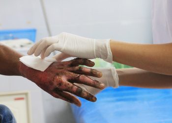 BURN INJURY