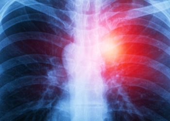 Mesothelioma